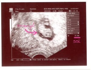Ultraschallbild eines Embryos
